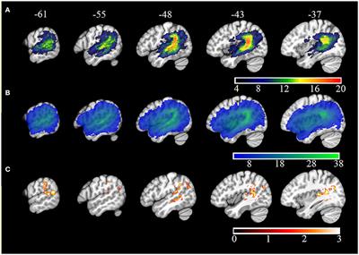 Sources of Phoneme Errors in Repetition: Perseverative, Neologistic, and Lesion Patterns in Jargon Aphasia